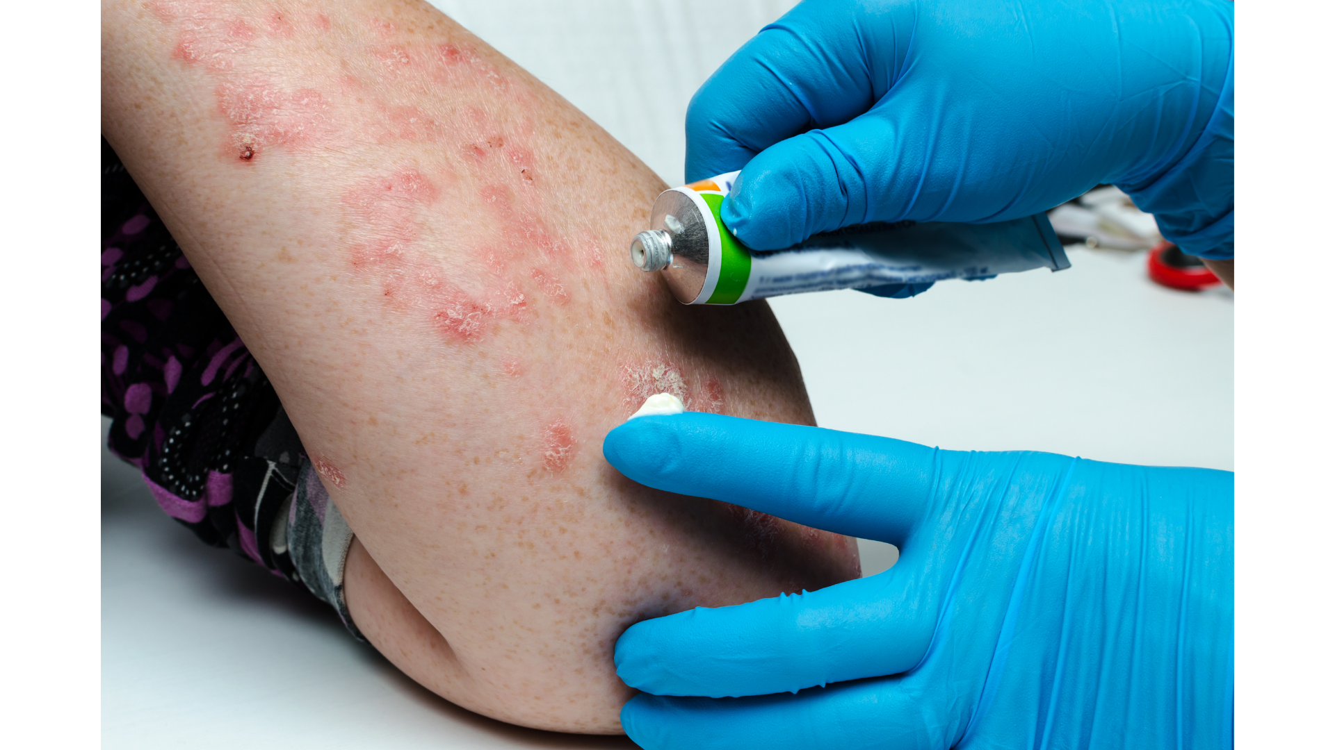 B&aacute;c sĩ ơi: Sai lầm chữa trị n&agrave;o khiến bệnh vảy nến trở n&ecirc;n trầm trọng hơn? - Ảnh 1.