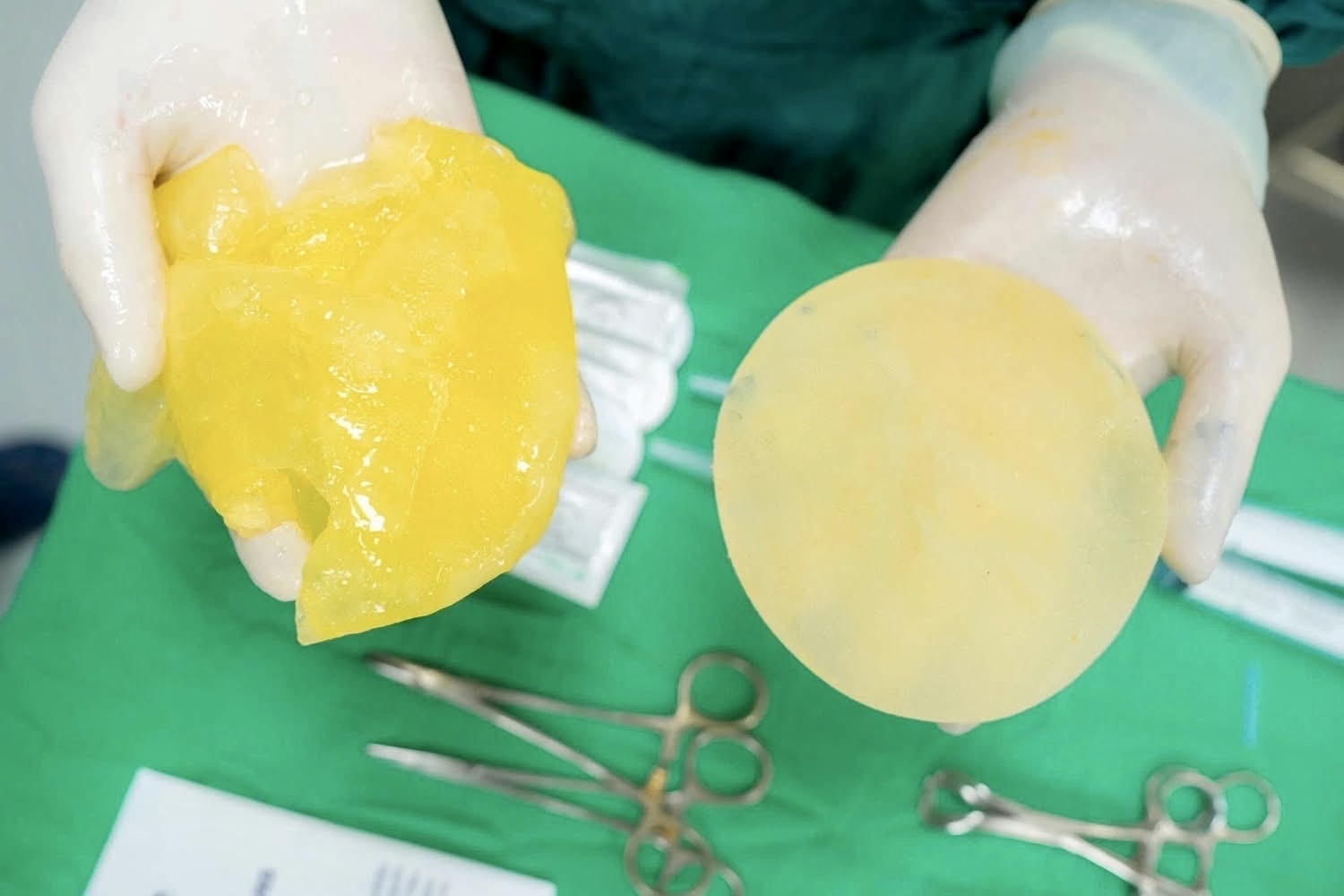 T&uacute;i n&acirc;ng ngực c&oacute; dễ vỡ khi chơi thể thao? - Ảnh 1.