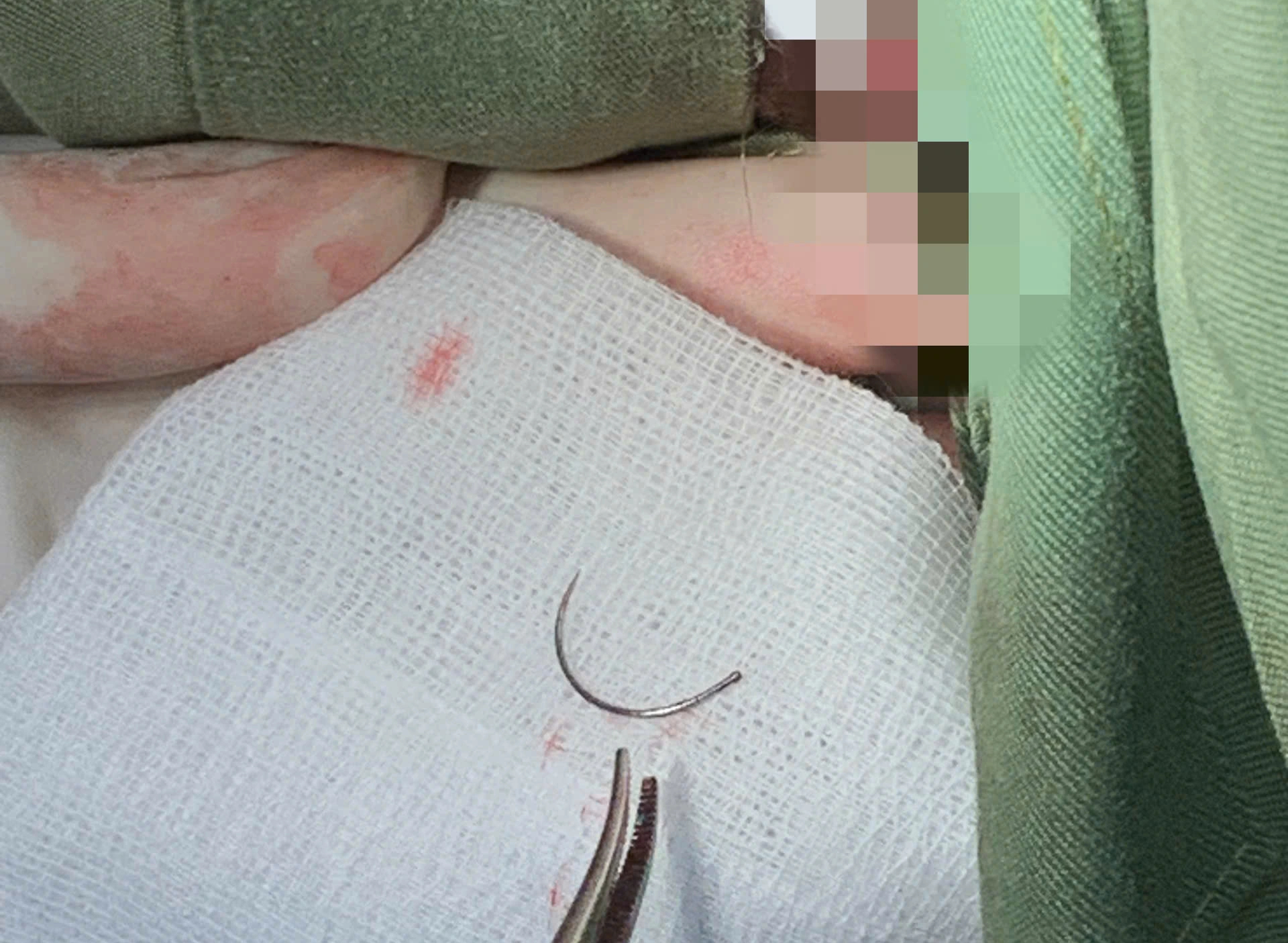 Lấy Thành Công Đoạn Kim Khâu Bị Mắc Kẹt Trong Cơ Thể Người Phụ Nữ 11 Năm- Ảnh 1. Lấy Thành Công Đoạn Kim Khâu Bị Mắc Kẹt Trong Cơ Thể Người Phụ Nữ 11 Năm- Ảnh 1.