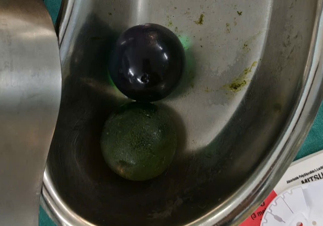 Tưởng Hạt Nở Là Thạch, Bé 1 Tuổi Tắc Ruột Phải Mổ Cấp Cứu Tưởng Hạt Nở Là Thạch, Bé 1 Tuổi Tắc Ruột Phải Mổ Cấp Cứu - Ảnh 1.