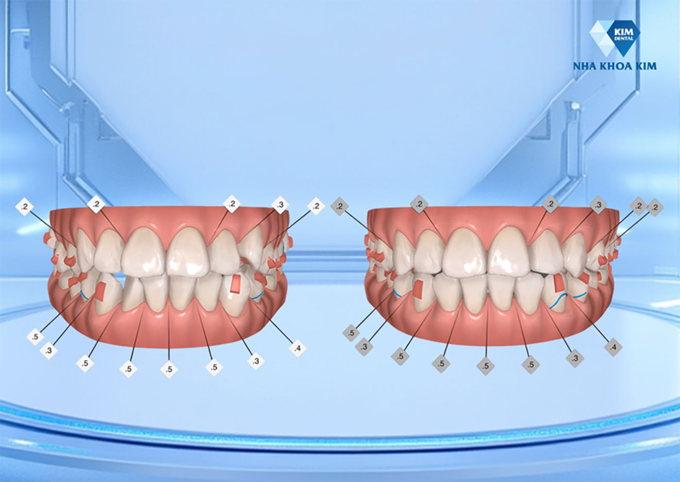 Niềng Răng 2026: Khi An Toàn Trở Thành ‘Lựa Chọn' Đầu Tư Mới Của Giới Trẻ Niềng Răng 2026: Khi An Toàn Trở Thành ‘Lựa Chọn' Đầu Tư Mới Của Giới Trẻ - Ảnh 2.