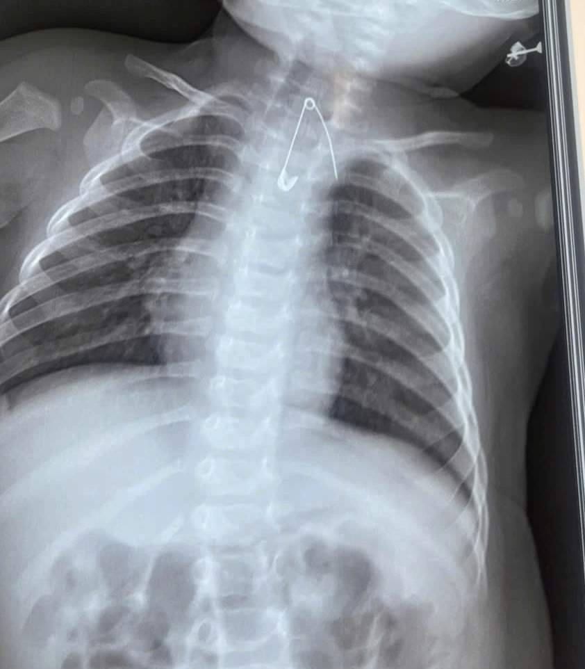 Hai Ca Dị Vật Đặc Biệt Nguy Kịch Ở Trẻ Nhỏ Cứu Kịp Thời Tại Cà Mau - Ảnh 2.