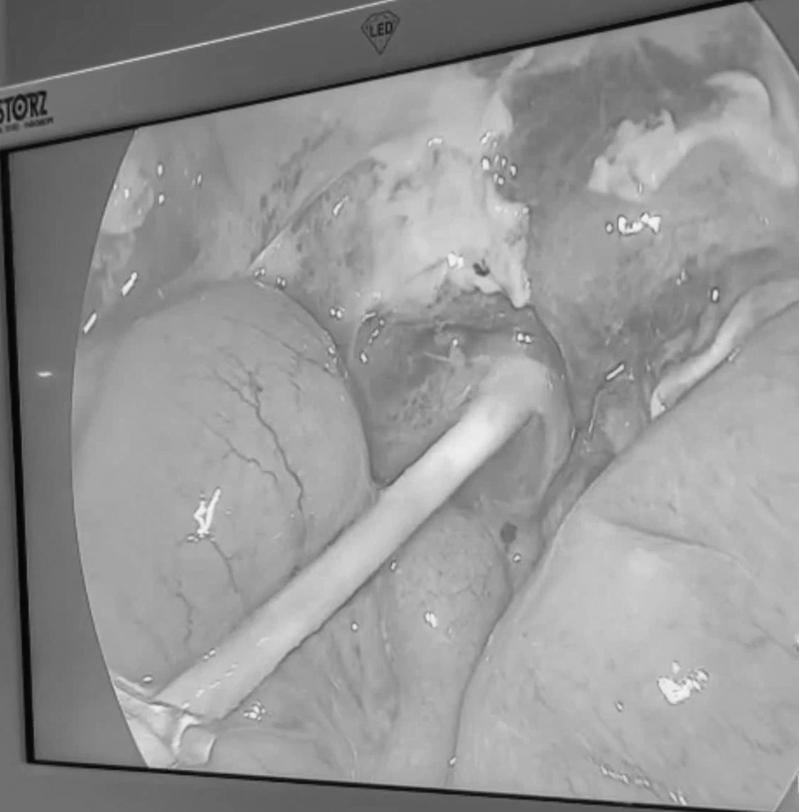 Hai Ca Dị Vật Đặc Biệt Nguy Kịch Ở Trẻ Nhỏ Cứu Kịp Thời Tại Cà Mau - Ảnh 1.