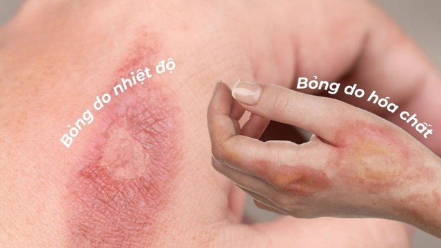 Cứ nghĩ sẹo bỏng phải xâm lấn nhưng dùng kem mờ sẹo vẫn hiệu quả nhanh chóng - Ảnh 1.