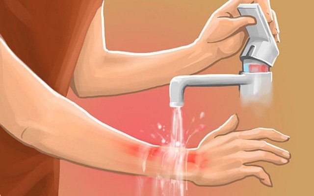 Cứ nghĩ sẹo bỏng phải xâm lấn nhưng dùng kem mờ sẹo vẫn hiệu quả nhanh chóng - Ảnh 3.