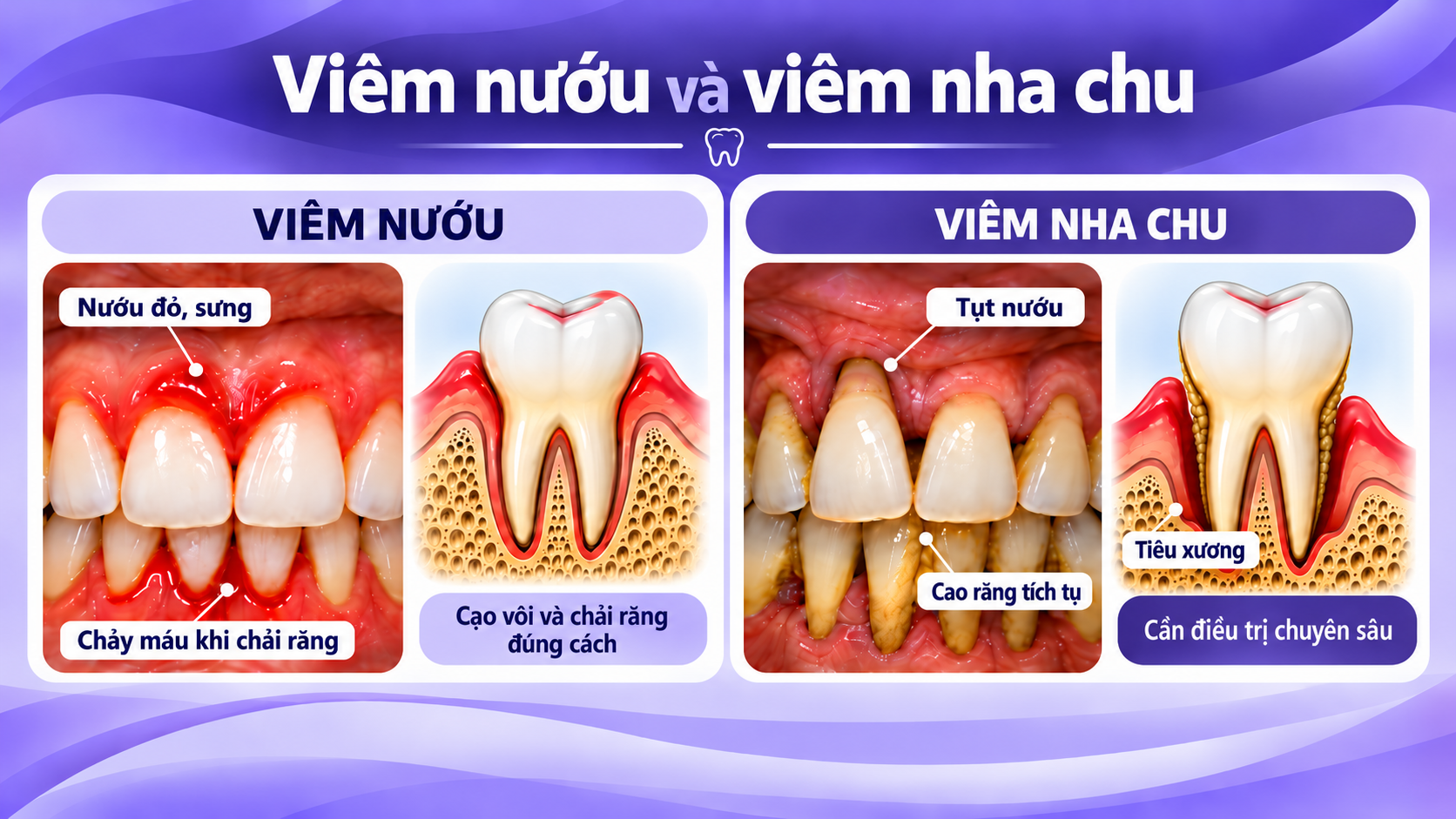 Chảy máu khi đánh răng, nên dừng hay chải nhiều hơn? - Ảnh 2.