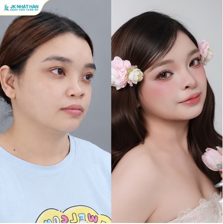 Mẹ đơn thân GenZ tìm lại tự tin sau phẫu thuật tái tạo mũi môi dị tật - Ảnh 2.