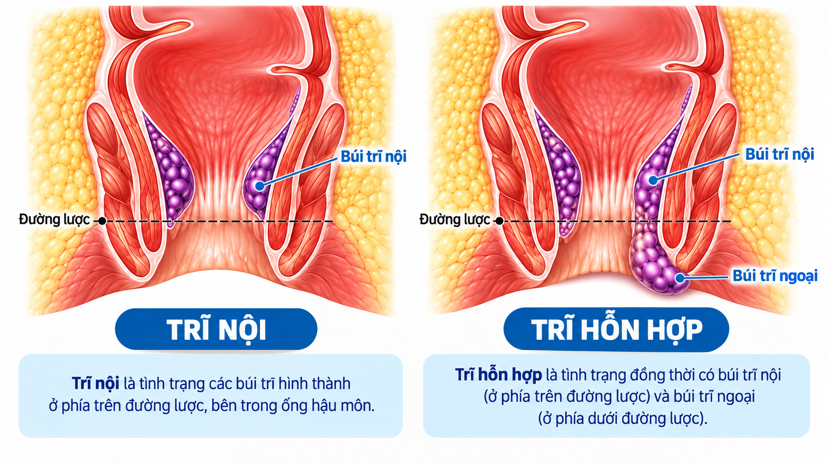 Đi tiêu ra máu kéo dài, người đàn ông phát hiện trĩ kèm thiếu máu nặng - Ảnh 1.