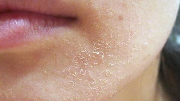 Giải mã lotion dưỡng ẩm, kiềm dầu cho da mụn nhạy cảm đang được chú ý- Ảnh 1.