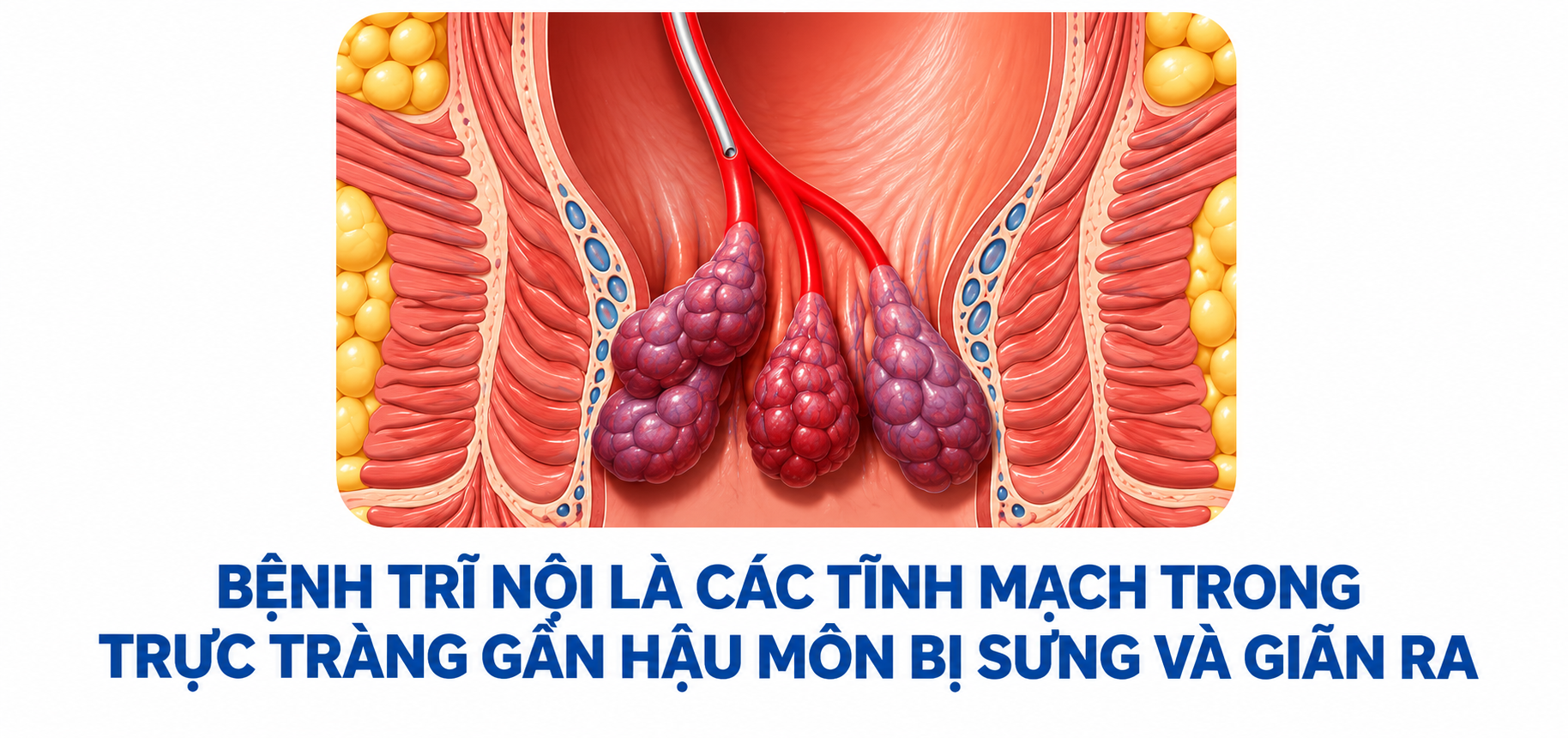 Tại sao cùng sa búi trĩ, người sinh hoạt bình thường, người lại phải phẫu thuật? - Ảnh 1.