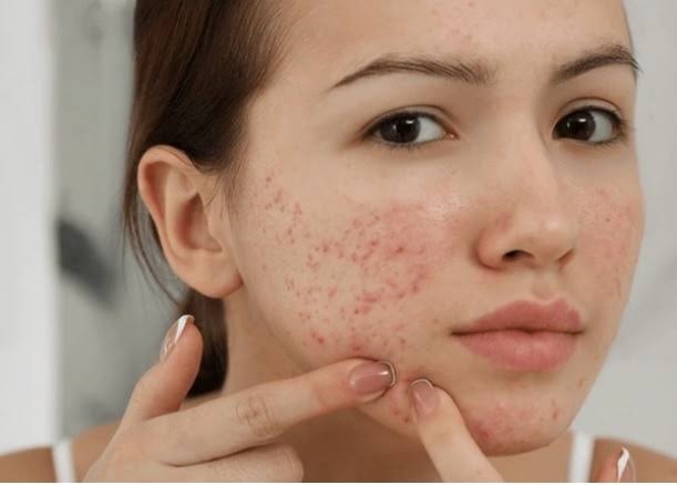 Da dầu mụn cứ skincare là bít tắc: Bạn có đang bỏ quên bước quan trọng này?- Ảnh 3.