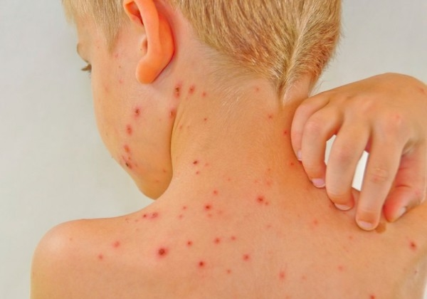 Kem bôi sẹo nào tốt cho bé đang được nhiều bố mẹ săn đón hiện nay? - Ảnh 3.