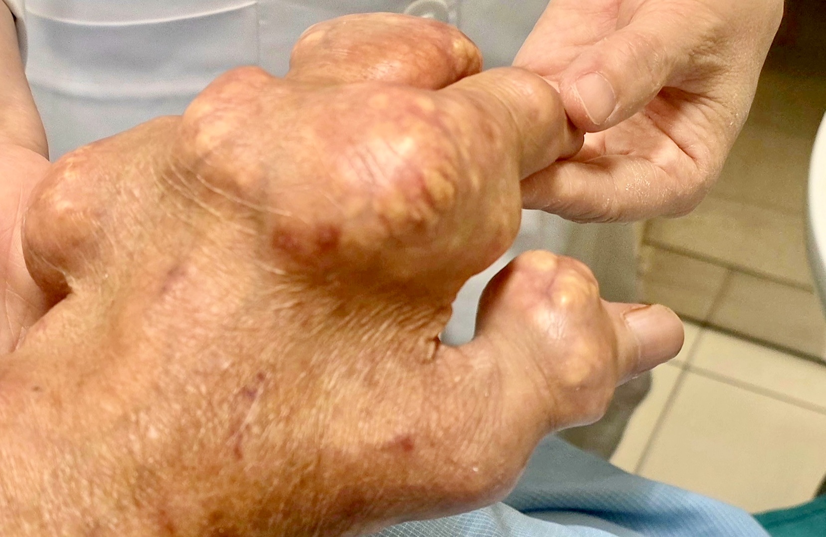 Người bị gout có nên ăn ức gà thay thế hoàn toàn thịt lợn, bò?- Ảnh 1.