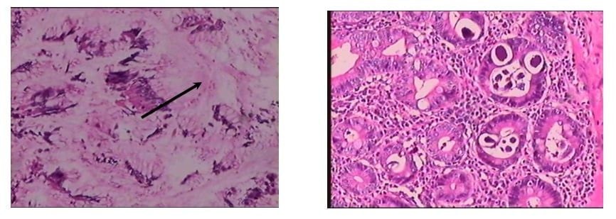 Đi chân đất, dùng corticoid tùy tiện: Nguy cơ giun lươn gây biến chứng tử vong - Ảnh 1.