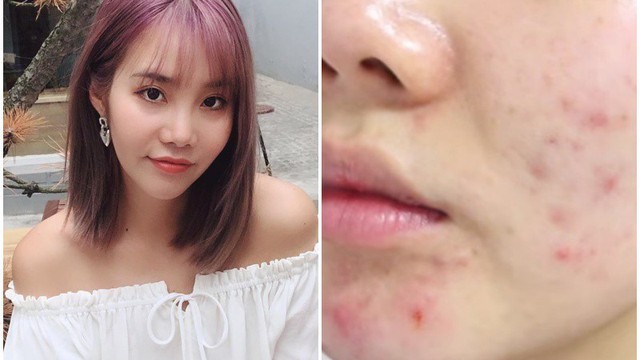 S&aacute;t Tết mới cuống skincare: 5 sai lầm khiến da &lsquo;banh&rsquo; kh&ocirc;ng kịp phục hồi- Ảnh 2.