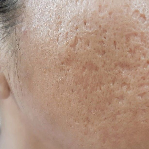 V&igrave; sao da sau mụn dễ th&acirc;m v&agrave; để lại sẹo? - Ảnh 3.