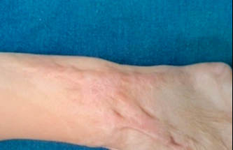 Trẻ 4 tuổi bị bỏng nặng do ngã vào nồi nước sôi trong ngày tết 2026 - Ảnh 1. Trẻ 4 tuổi bị bỏng nặng do ngã vào nồi nước sôi trong ngày tết 2026 - Ảnh 1.