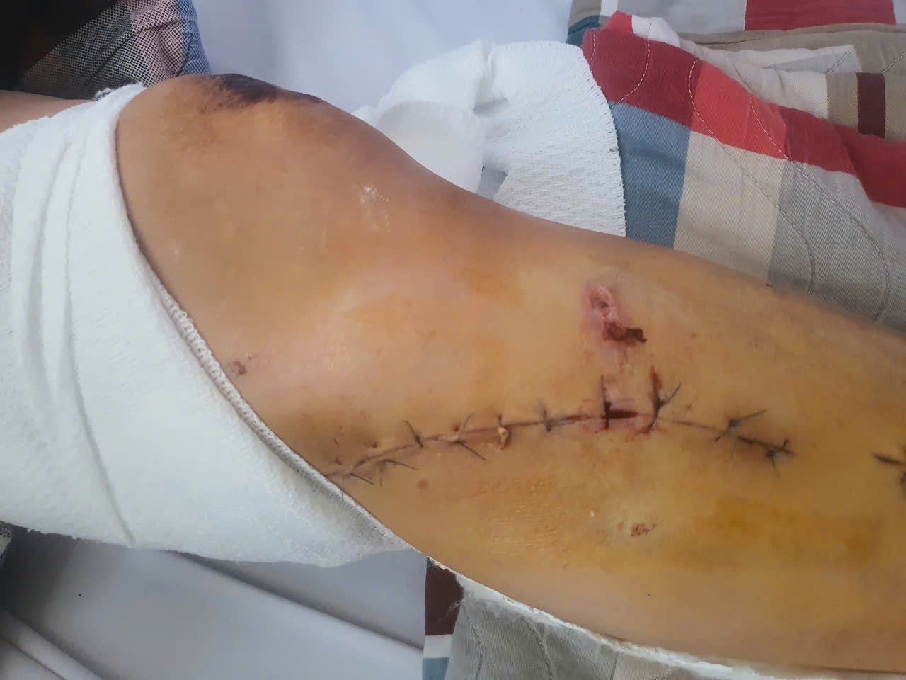 Phẫu thuật cứu bàn chân 3 tiếng cho người phụ nữ bị tai nạn giao thông - Ảnh 3. Phẫu thuật cứu bàn chân 3 tiếng cho người phụ nữ bị tai nạn giao thông - Ảnh 3.