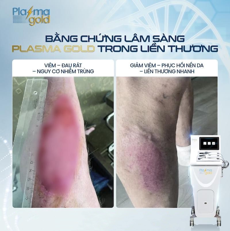 Cold Plasma có gây đau hay châm chích khi ứng dụng trong lâm sàng?- Ảnh 5.