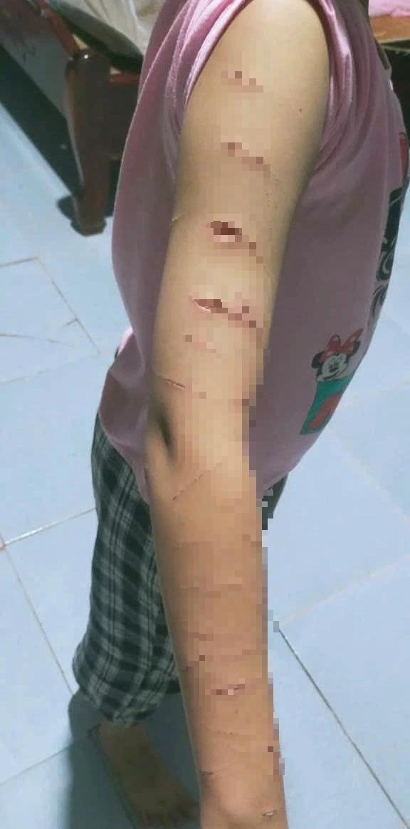 Cà Mau: Học sinh lớp 5 đến lớp với vết thương nghi bị chị họ bạo hành  - Ảnh 1.
