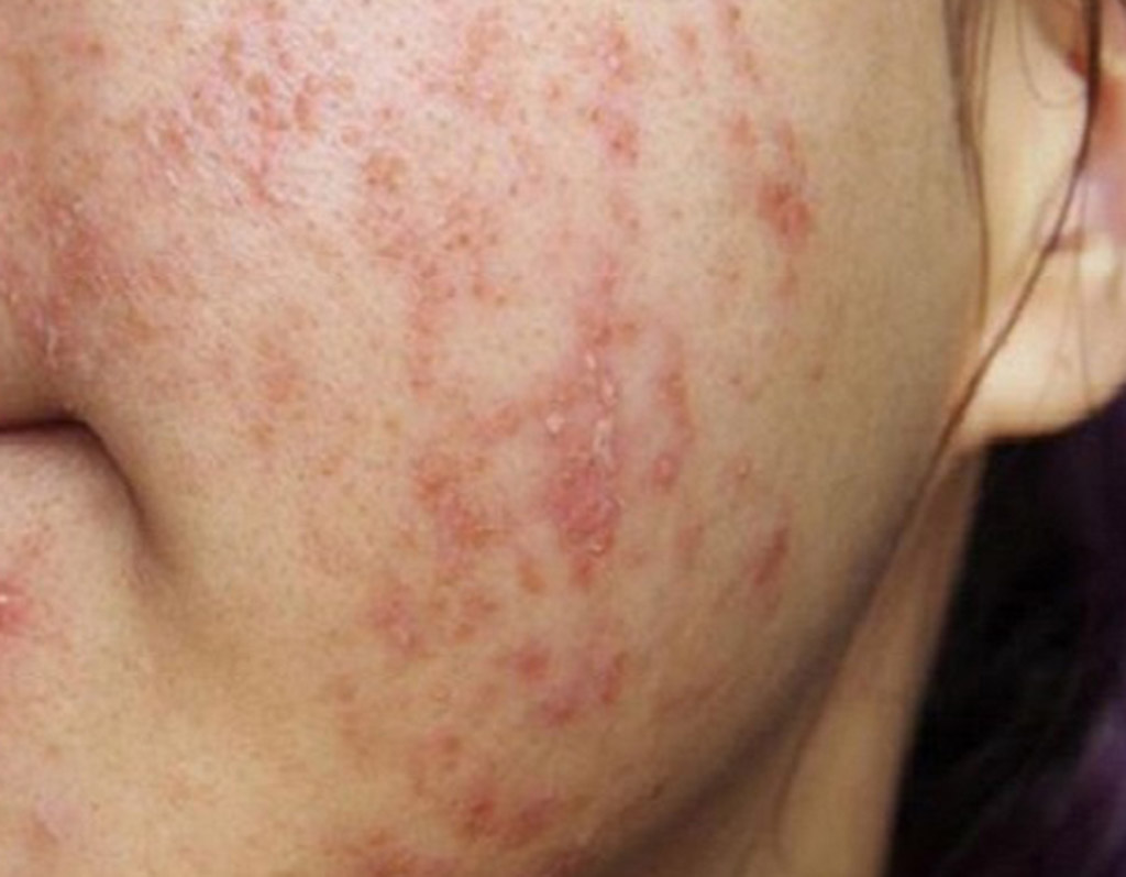 Bác Sĩ Da Liễu Cảnh Báo Về Trào Lưu Sử Dụng Và 'Đào Thải Corticoid' Trên Mạng - Ảnh 1.