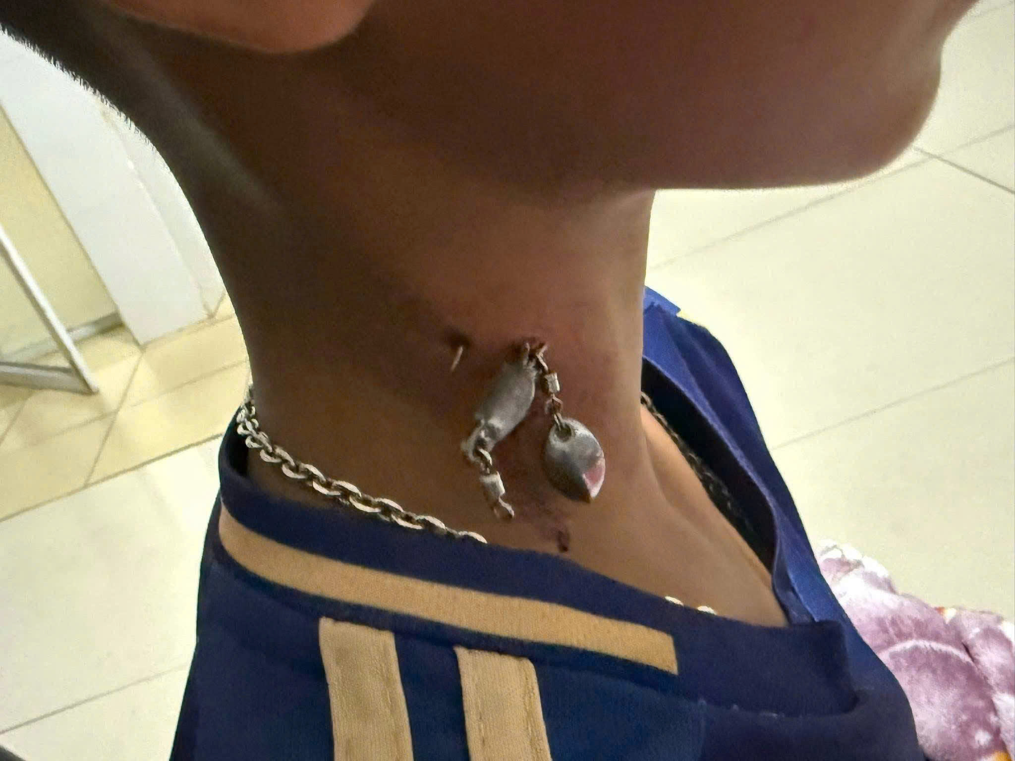 Móc câu mắc sâu vào cổ bệnh nhi 13 tuổi ở Quảng Trị- Ảnh 1.