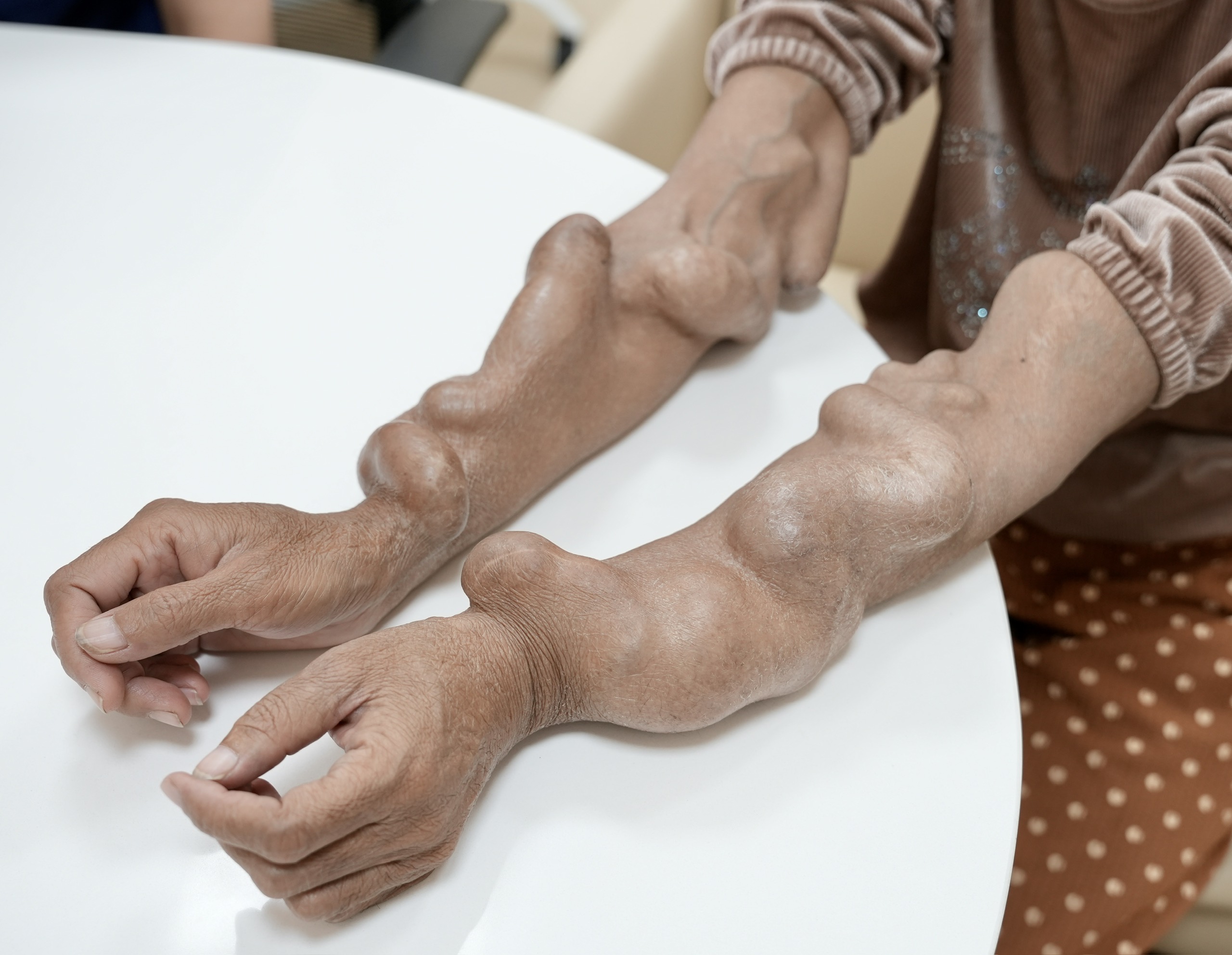 Điều Trị Ca Bệnh Thận Nhân Tạo Biến Dạng Tay Do Giãn Tĩnh Mạch - Ảnh 1.