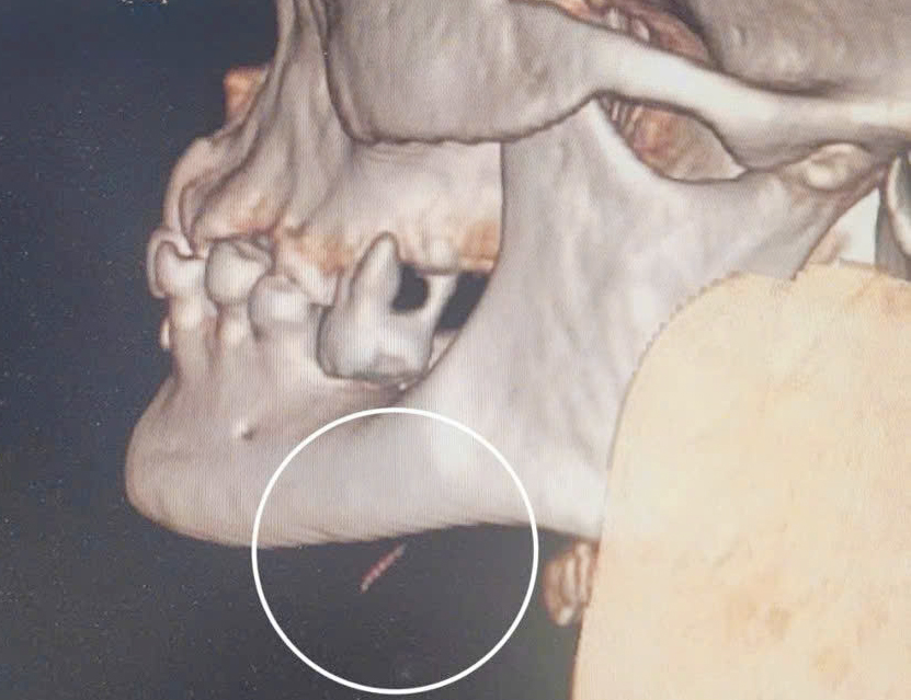 Cụ bà 77 tuổi bị áp xe dưới cằm do dị vật xương cá- Ảnh 1.