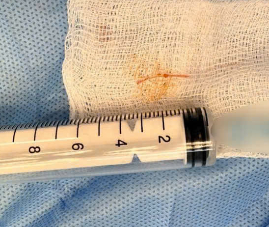 Cụ bà 77 tuổi bị áp xe dưới cằm do dị vật xương cá- Ảnh 2.