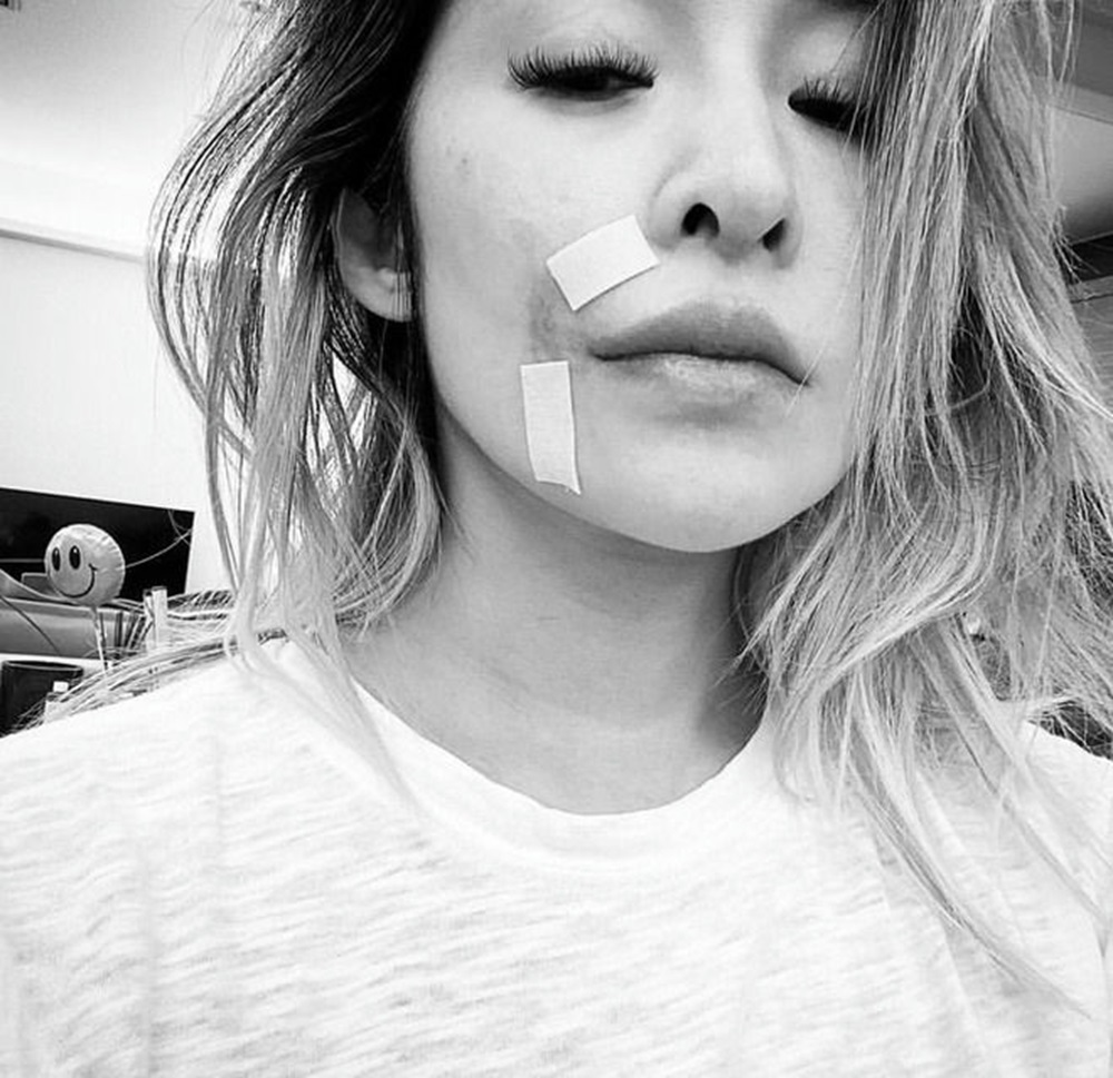 Diva Đài Loan Tiêu Á Hiên biến dạng gương mặt sau khi bị chó tấn công - Ảnh 1.