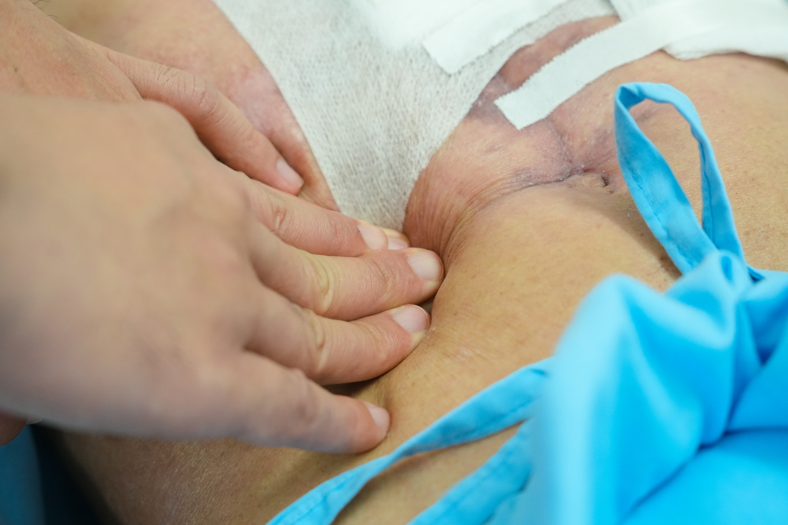 Đau bụng nhưng tự uống thuốc, người đàn ông bị thủng dạ dày, ngưng tim trên bàn mổ- Ảnh 1.