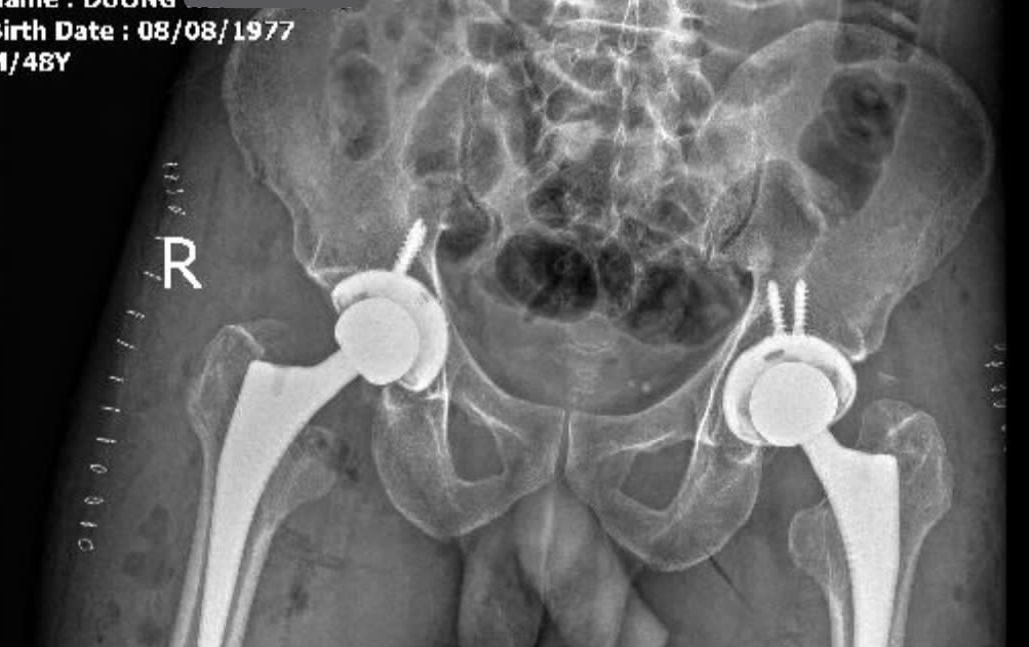 Đau khớp háng nhiều năm, đi khám phát hiện bị hoại tử xương cả hai bên đùi - Ảnh 2.