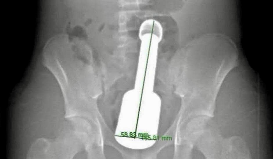 Chày Kim Lọai Mắc Kẹt Trong Trực Tràng: Câu Chuyện Cấp Cứu Bất Ngờ Tại Hà Đông - Ảnh 1.