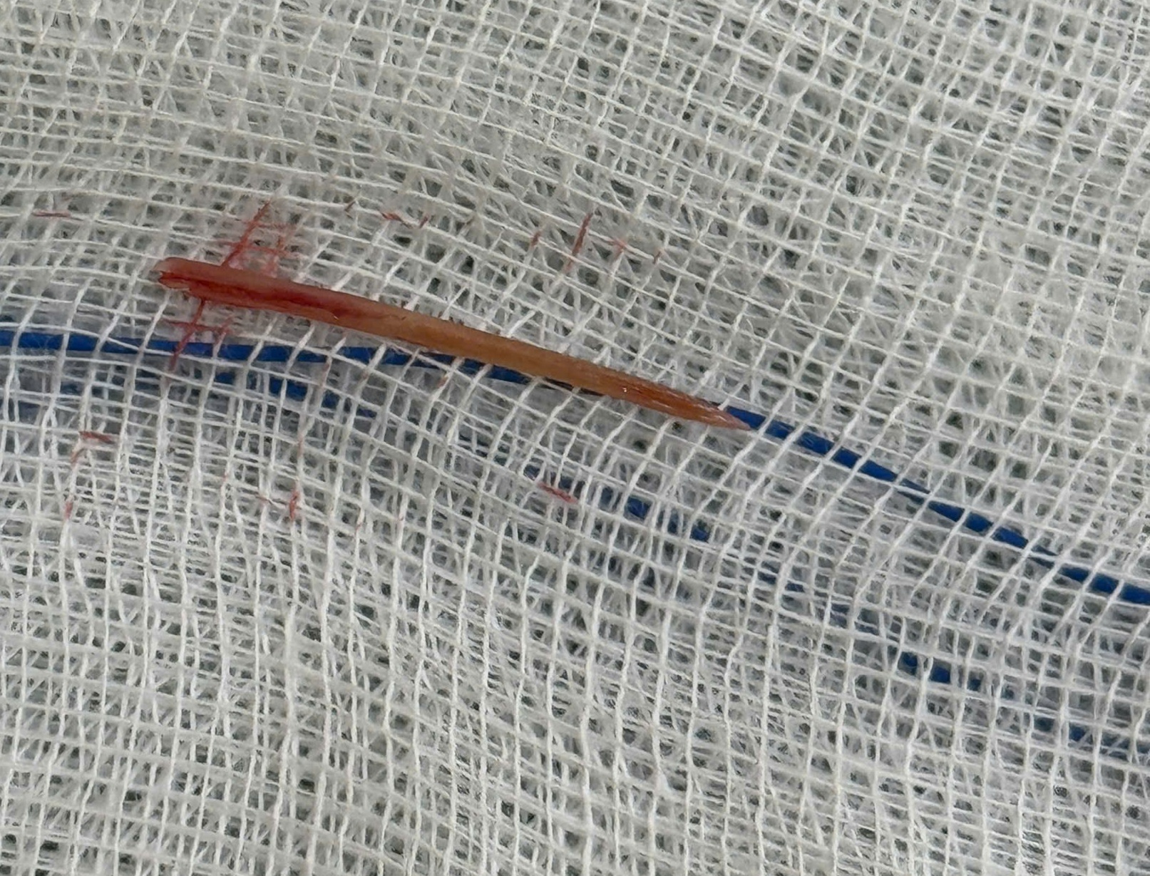 Đau Bụng 5 Ngày, Đi Khám Phát Hiện Xương Cá Đâm Xuyên Ruột Non Đau Bụng 5 Ngày, Đi Khám Phát Hiện Xương Cá Đâm Xuyên Ruột Non - Ảnh 1.