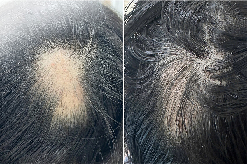 Nguyên nhân khiến thiếu nữ 16 tuổi rụng tóc từng mảng - Ảnh 2.