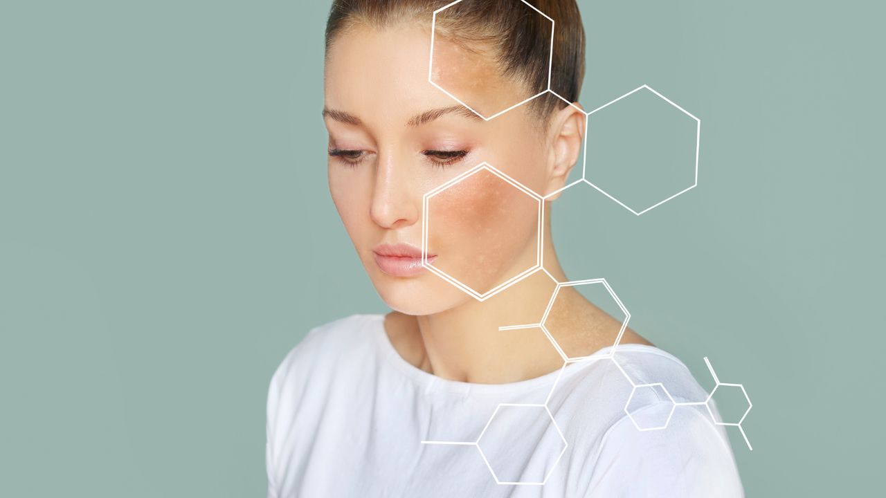 Cách phân biệt giữa tăng sắc tố và nám da để điều trị đúng- Ảnh 1. Cách phân biệt giữa tăng sắc tố và nám da để điều trị đúng- Ảnh 1.