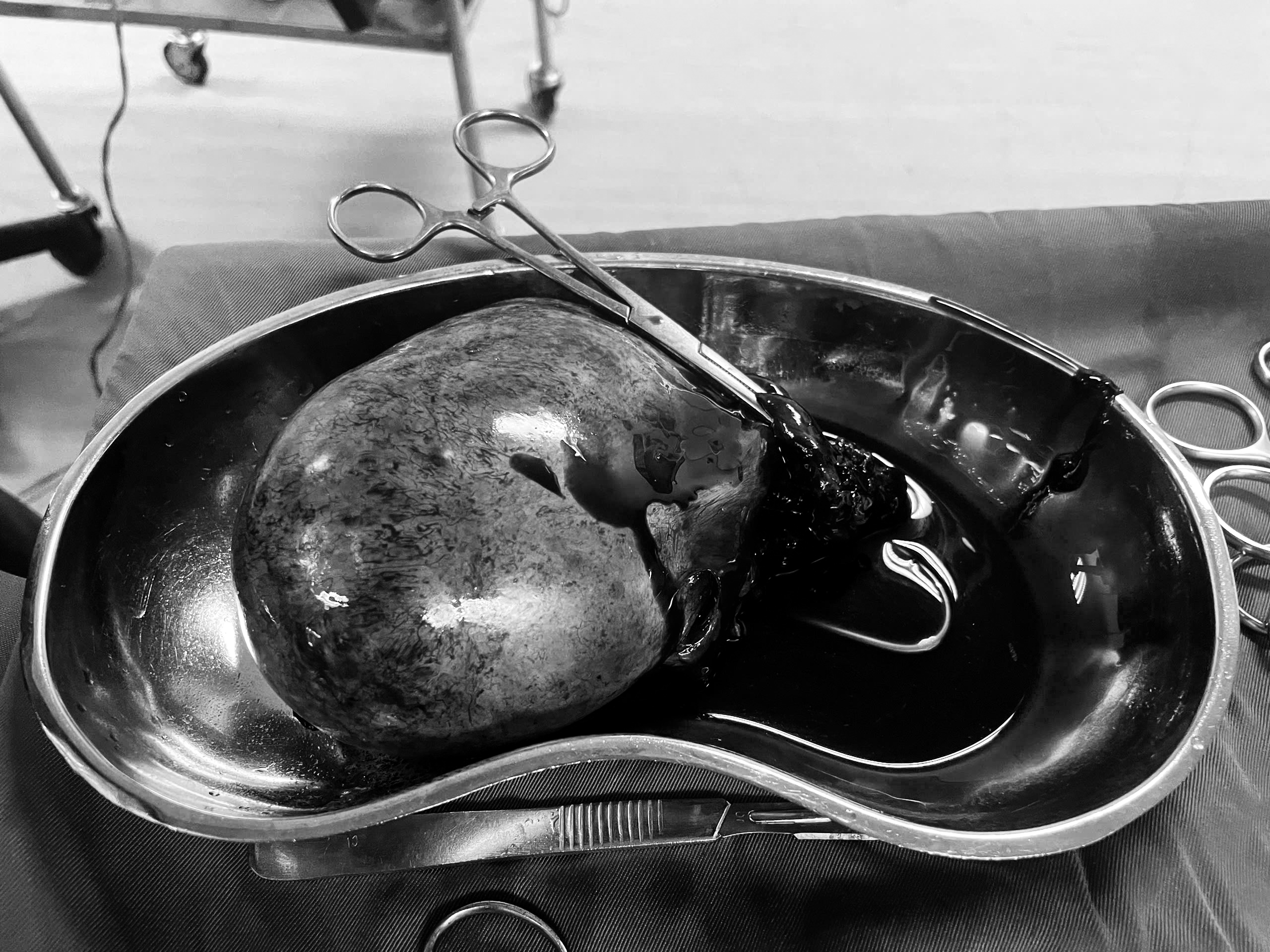 Cấp cứu sản phụ bị u nang buồng trứng kích thước gần 10 cm - Ảnh 2.