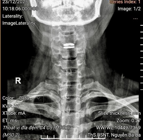 Đau cổ vai g&aacute;y dẫn đến nguy cơ liệt do tổn thương tủy sống - Ảnh 1.