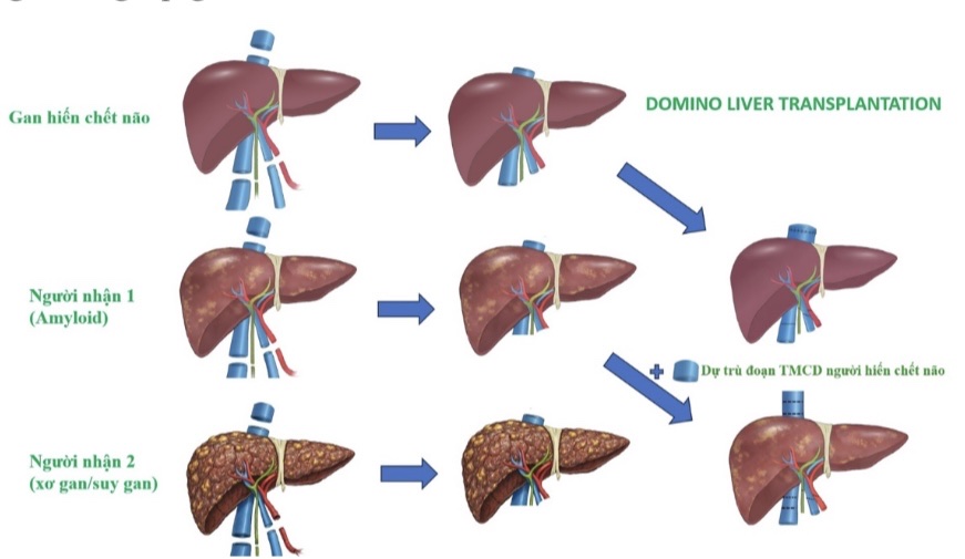 Lần đầu tiên thực hiện 'ghép đa tạng domino' tại Việt Nam- Ảnh 1.