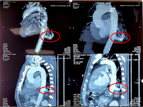  Lần đầu dùng robot mổ điều trị phổi biệt lập thành công - Ảnh 1.