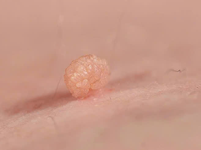 Tình dục không an toàn, nam bệnh nhân gần 70 tuổi mắc sùi mào gà - Ảnh 1.