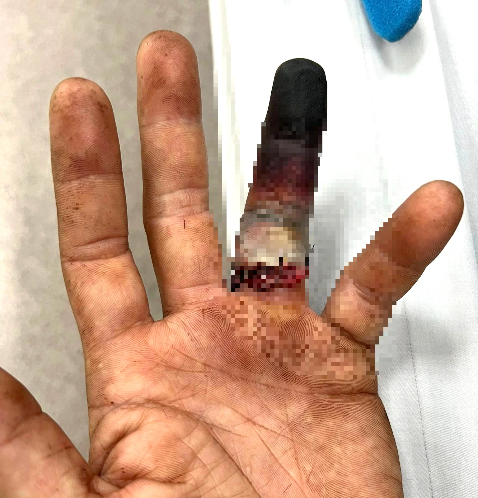 Nam thanh niên mất ngón tay vì nhẫn cưới bị kẹt khi nhảy khỏi xe tải - Ảnh 1.