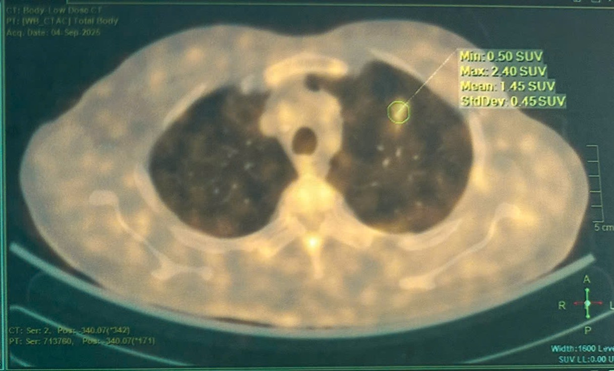 Bệnh viện Bạch Mai phát triển AI hỗ trợ chẩn đoán chính xác ung thư phổi 19 Bệnh viện Bạch Mai phát triển AI hỗ trợ chẩn đoán chính xác ung thư phổi - Ảnh 1.