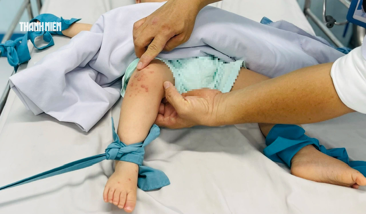 Bác sĩcảnh báo dấu hiệu dễ bị bỏ sót bệnh tay chân miệng ở trẻ - Ảnh 1.