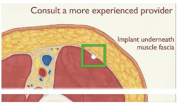 Bệnh viện Phương Nam xử tr&iacute; ca que tr&aacute;nh thai xuy&ecirc;n s&acirc;u v&agrave;o cơ hiếm gặp - Ảnh 1.