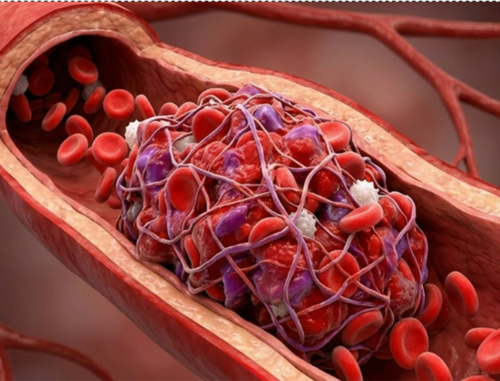 Ngày mới với tin tức sức khỏe: Người tiểu đường cần cảnh giác với đột quỵ - Ảnh 1.