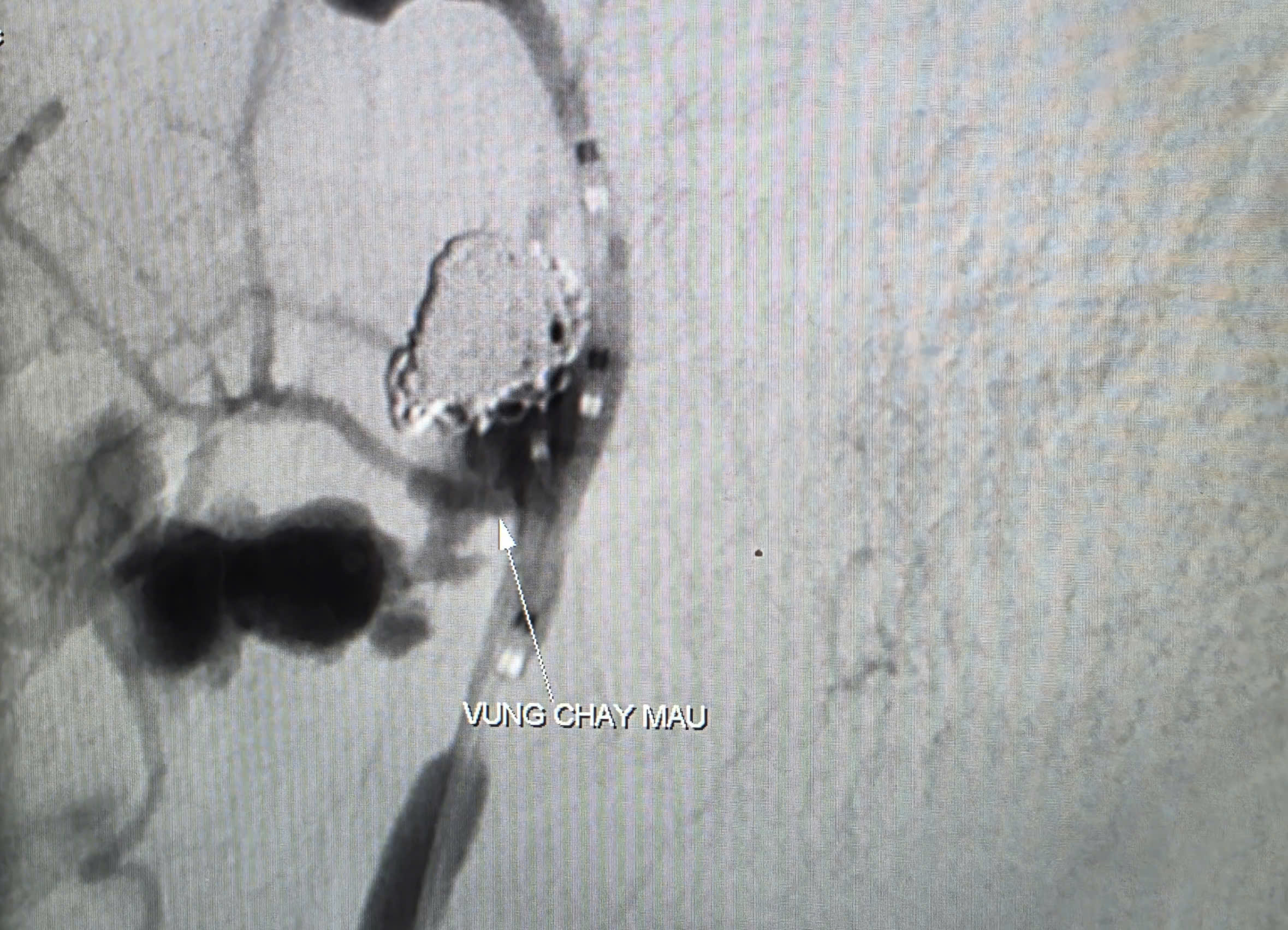  Cứu sống bệnh nhân ung thư biến chứng chảy máu ồ ạt - Ảnh 1.