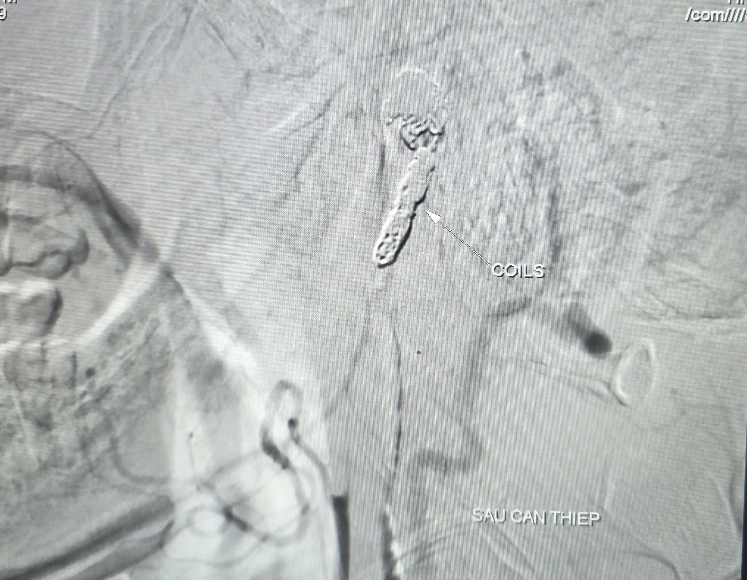  Cứu sống bệnh nhân ung thư biến chứng chảy máu ồ ạt - Ảnh 2.