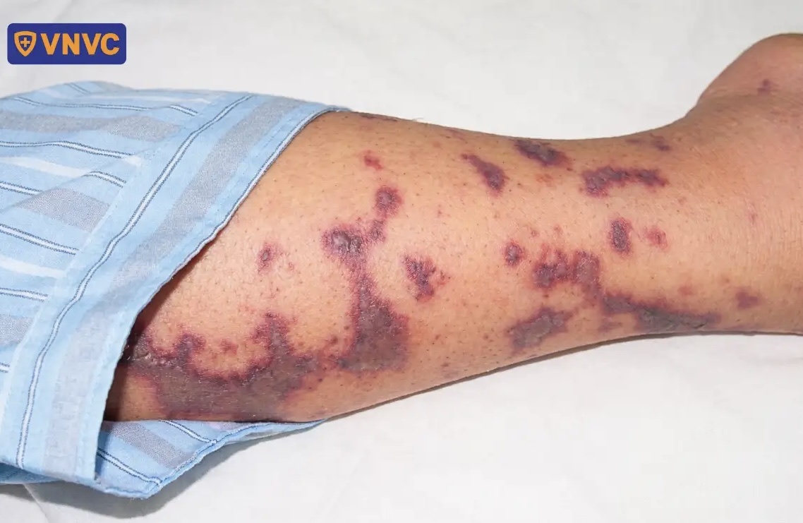 4 ca tử vong do bệnh não mô cầu, nguy cơ xuất hiện thêm các ca bệnh- Ảnh 1. 4 ca tử vong do bệnh não mô cầu, nguy cơ xuất hiện thêm các ca bệnh- Ảnh 1.