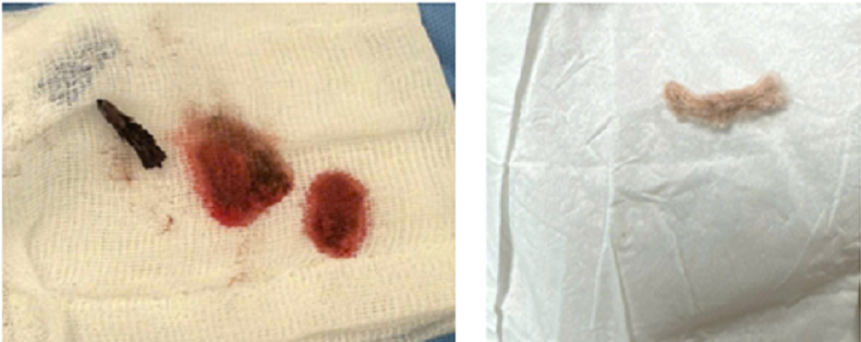 Bé 3 tuổi ho ra máu, đi viện phát hiện dị vật kẽm nhung dài 2cm - Ảnh 1.